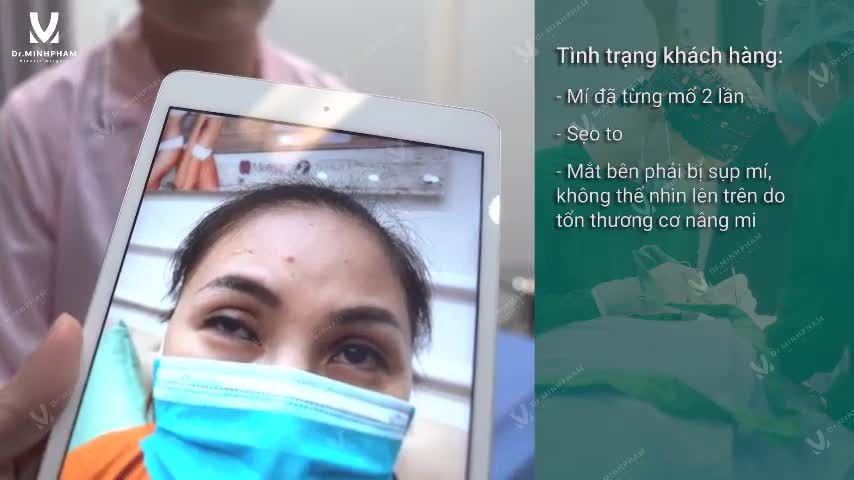 MẮT 2 MÍ - ĐẸP XINH HẾT Ý MÍ SILK PLUS - ĐỘC QUYỀN Dr. Minh Phạm 108