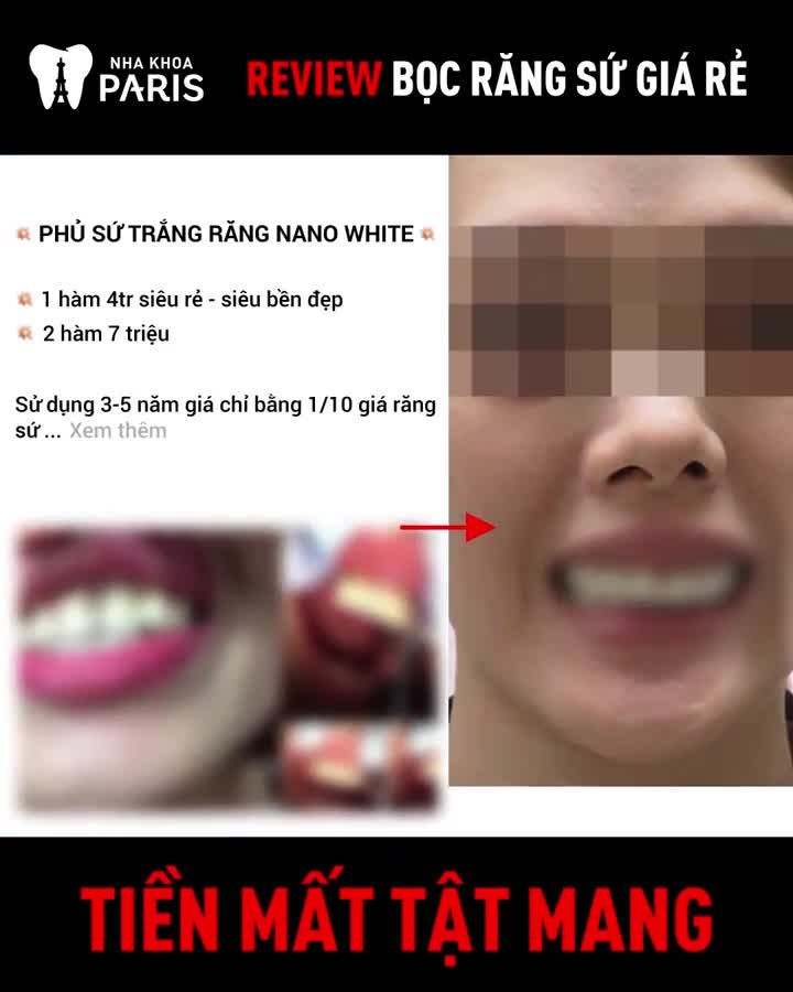 Mất Cả Hàm Răng Vì Bọc Răng Sứ Giá Rẻ