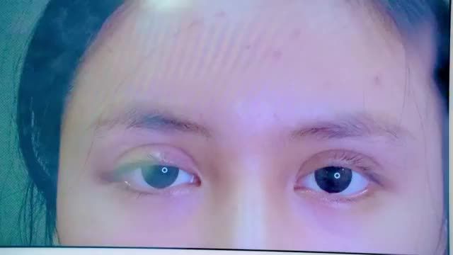 Mắt đứt cơ mi gây sụp cơ sau phẫu thuật cắt mí tại cơ sở kém chất lượng, thiếu uy tín dẫn đến biến chứng nặng