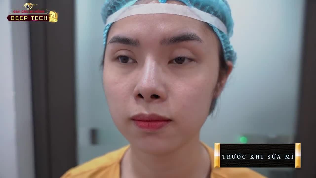 Mắt đứt cơ nâng mi gây liệt cơ Mắt biến dạng to nhỏ...Sẹo xơ cứng