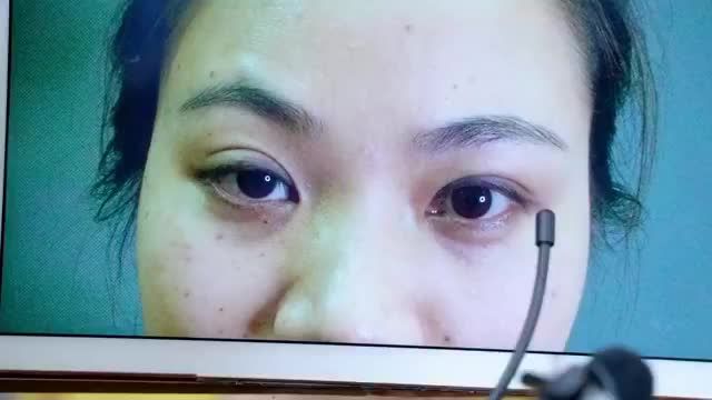 Mắt lỗi hỏng gây nhược cơ sụp mí xử lý khắc phục như thế nào? Theo dõi ngay video kết quả Sửa mí DeepTech sau đây