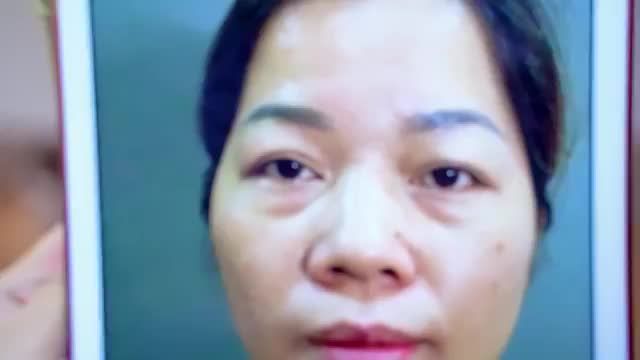 Mắt sụp mí tuổi trung niên quý khách hàng đừng quá lo lắng Đến ngay Dr.Hải Lê để có phương pháp cải thiện nhé!