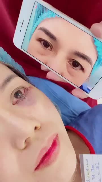 Mắt TRẺ HÓA ngay sau 60 phút tiêu phẫu Chắc chắn là lựa chọn Combo CẮT MÍ dưới + Xóa rãnh lệ rồi!