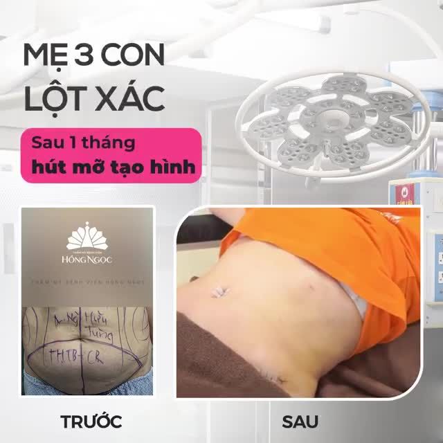 MẸ 3 CON LỘT XÁC SAU 1 THÁNG HÚT MỠ TẠO HÌNH