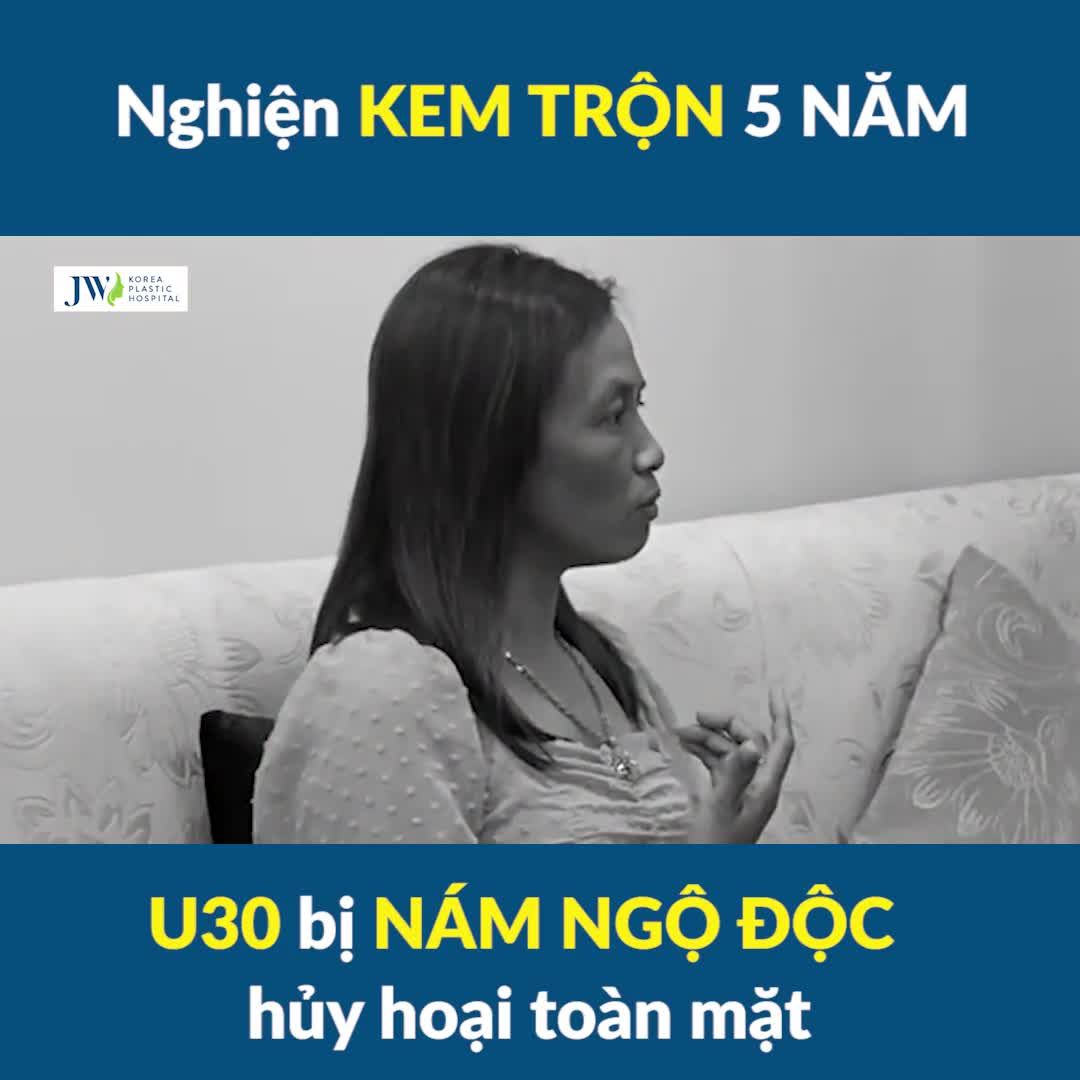 Mê mẩn KEM TRỘN 5 NĂM, U30 bị NÁM NGỘ ĐỘC hủy hoại toàn mặt