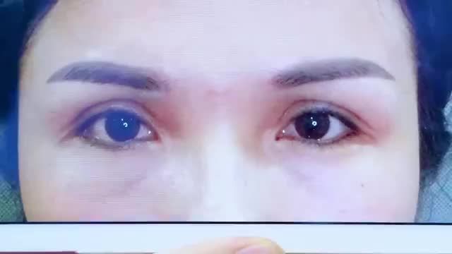 Mí hỏng sau nhiều năm có sửa lại được nữa không? Theo dõi kết quả Sửa mí sau 10 năm làm mí hỏng của vị khách hàng này để có thêm kinh nghiệm bạn nhé