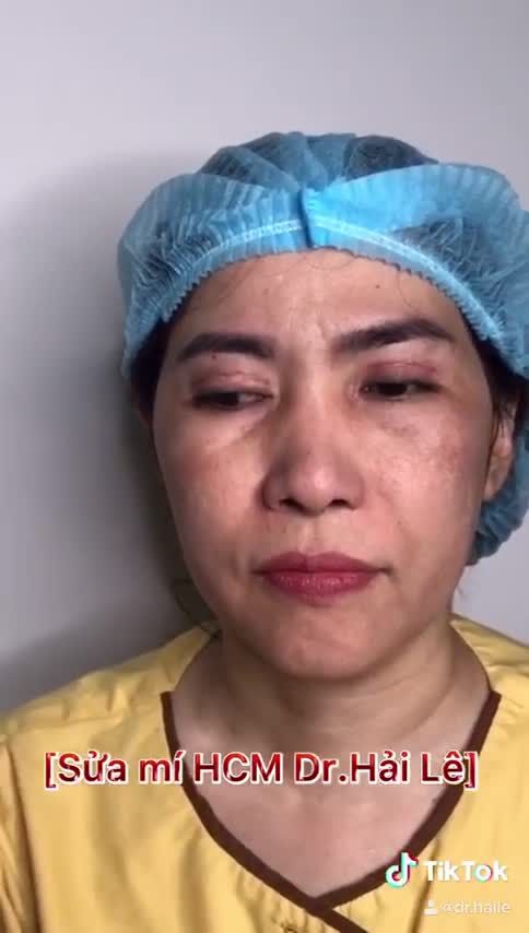 Mí tôi cắt ở spa bị hỏng và đây là kết quả sửa mí của tôi tại Dr.Hải Lê cơ sở HCM