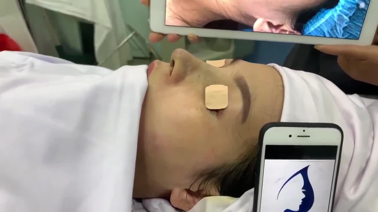 Mời cả nhà cùng chiêm ngưỡng mũi cấu trúc dáng latin vừa hoàn thành đẹp tuyệt!