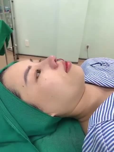 Mời cả nhà cùng theo dõi kết quả ca mũi sửa lại cấu trúc, cuốn cánh mũi, xử lý khuyết điểm sẹo đầu mũi cho bạn gái từng nâng 1 lần ở cơ sở thẩm mỹ khác nhưng không thành công nhé!