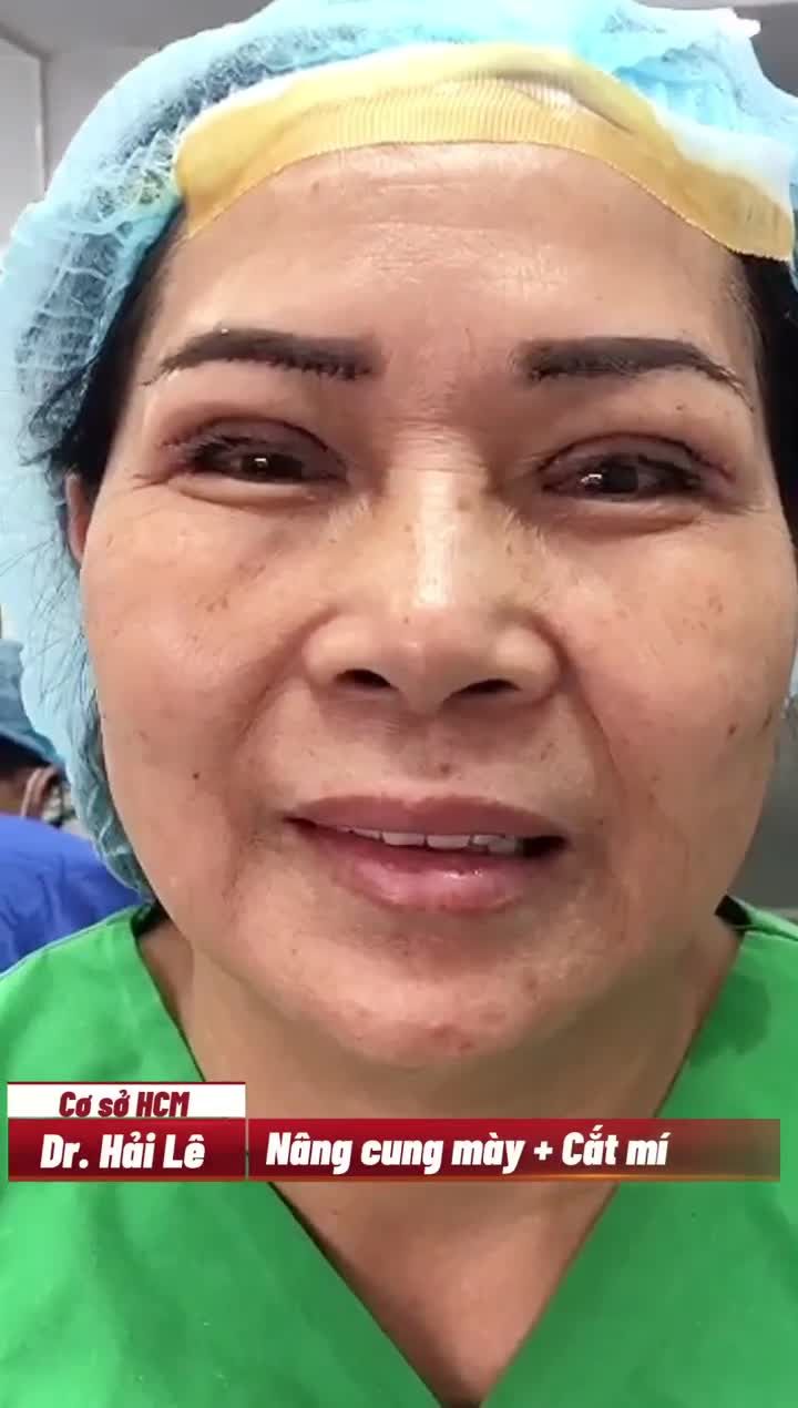 Mời quý khách hàng cùng theo dõi video chân thật kết quả Nâng cung mày + Cắt mí giúp khách hàng trẻ trung rạng rỡ vừa thực hiện xong tại cơ sở HCM!