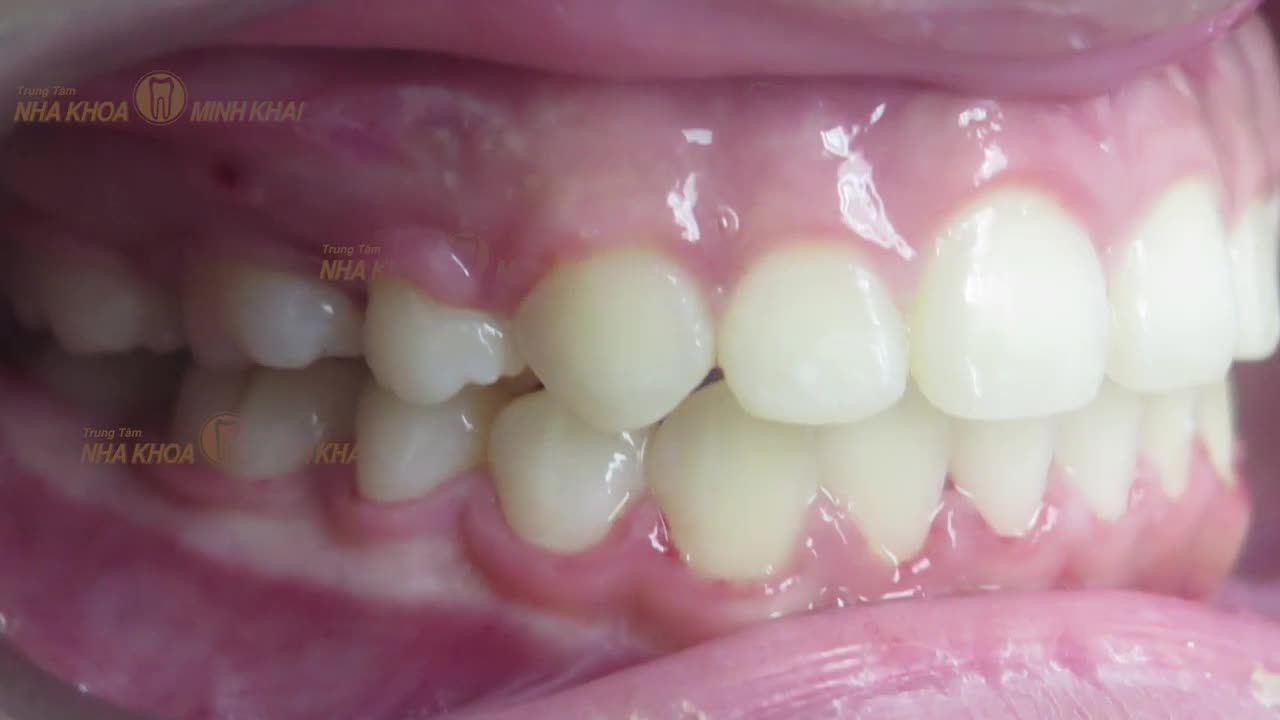 Một trong những trường hợp niềng răng ngay từ giai đoạn sớm tại Nha Khoa Minh Khai.