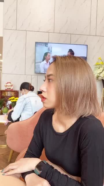 Mũi cấu trúc sụn tai - sóng Surgiform đẹp tự nhiên sau 4 tháng