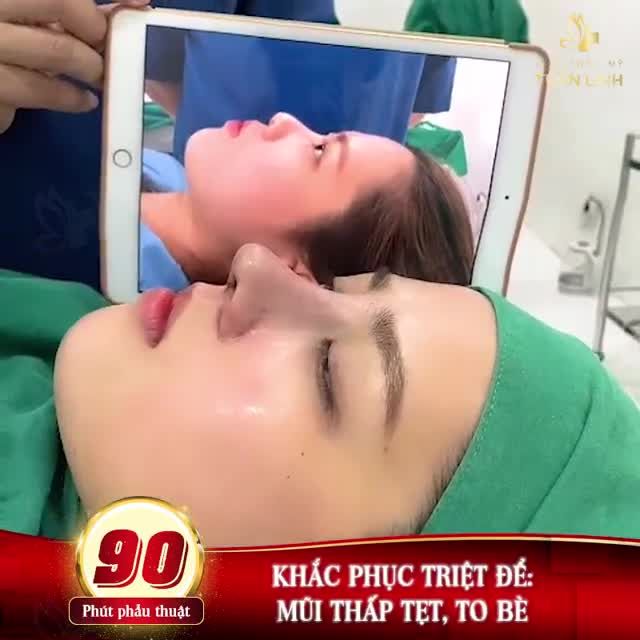 MŨI ĐẸP TỰ NHIÊN SAU 90 PHÚT
