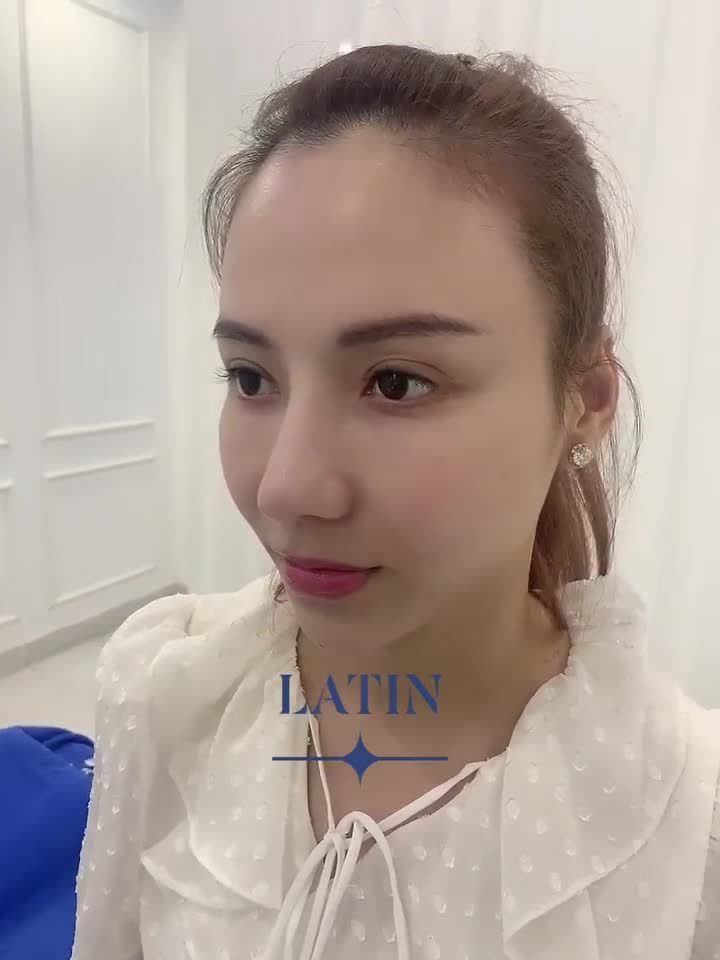 Mũi tái cấu trúc Latin phom cao tây cho e gái từng nâng cấu trúc tại Hàn Quốc ko thành công sau 3 tháng