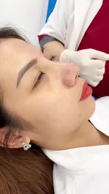 Mũi thấp - Da cánh mũi dày - Đầu mũi to Đâu là giải pháp