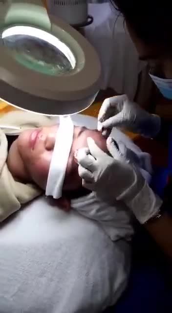 Mụn ẩn khiến da sần sùi, tổn thương NGHIÊM TRỌNG