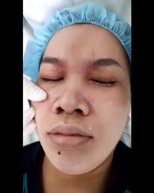 MỤN THỊT ban đầu chỉ là những nốt sẩn nhỏ nhưng sẽ lớn dần theo thời gian