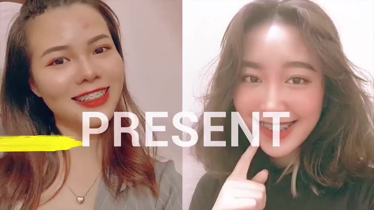 MUỐN CƯỜI TỰ TIN - NIỀNG RĂNG SẼ GIÚP BẠN