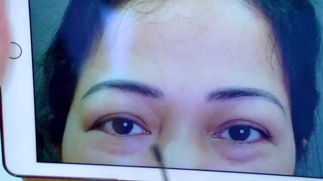 Nâng cung mày, giải pháp vàng giúp khách hàng tuổi ngoài 30 sở hữu đôi mắt đẹp trẻ trung rạng rỡ, xóa bỏ hoàn toàn sụp mí da chùng gây già nua u buồn