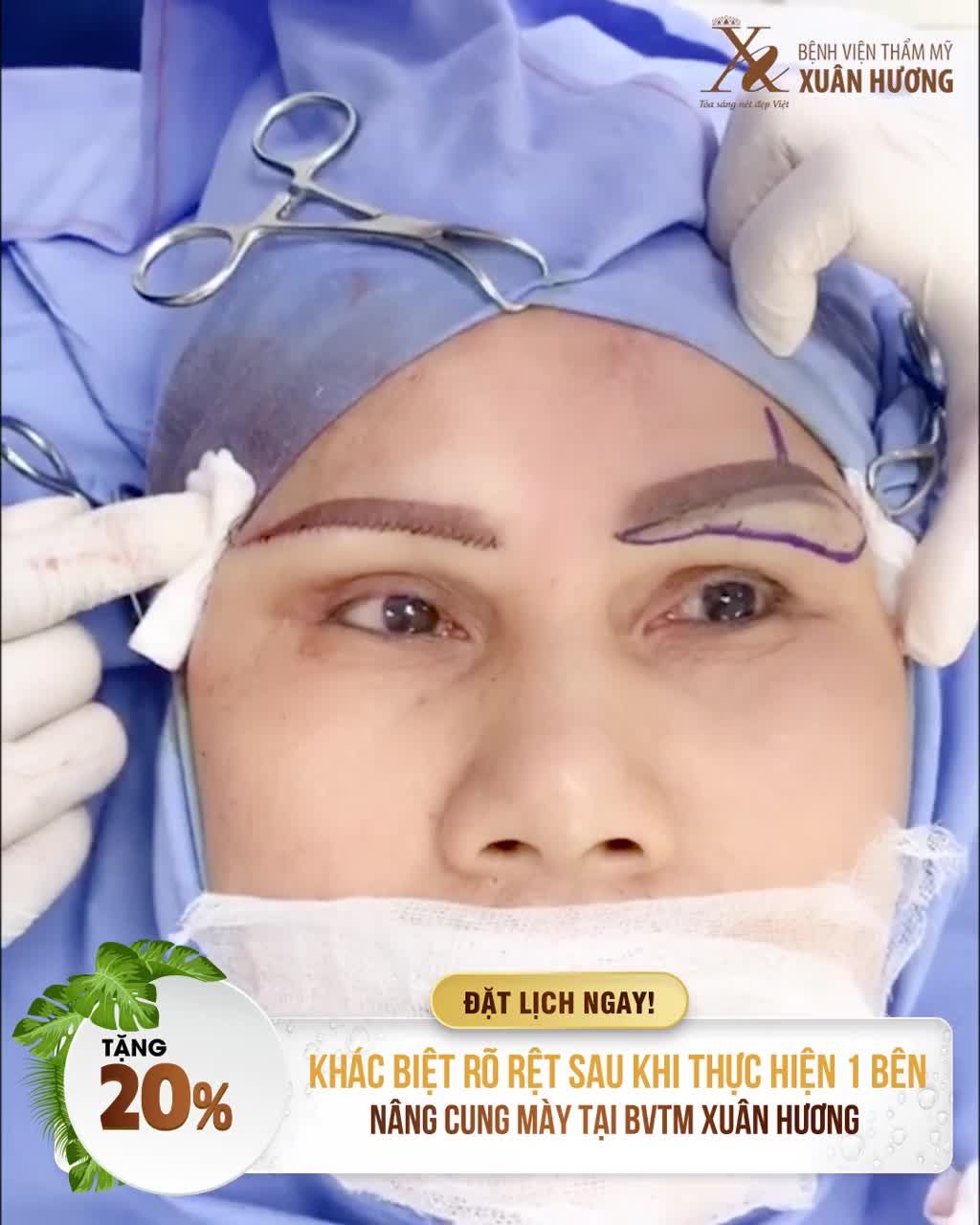 NÂNG CUNG MÀY MANG LẠI HIỆU QUẢ TRẺ HÓA MẮT ĐẾN BẤT NGỜ