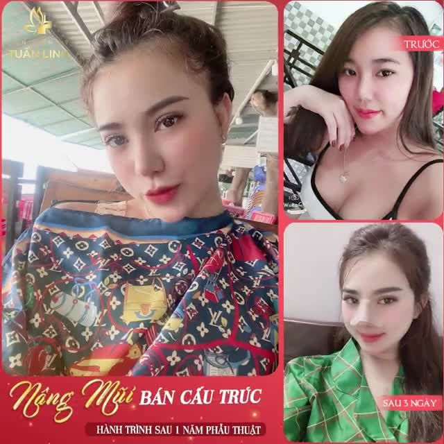 NÂNG MŨI BÁN CẤU TRÚC CÓ BỀN KHÔNG