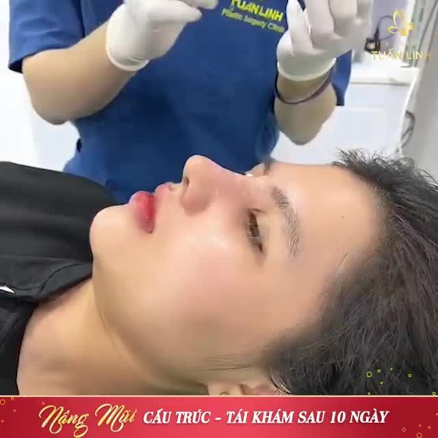 NÂNG MŨI CẤU TRÚC SAU 10 NGÀY CÓ NGAY "SIÊU PHẨM MŨI".