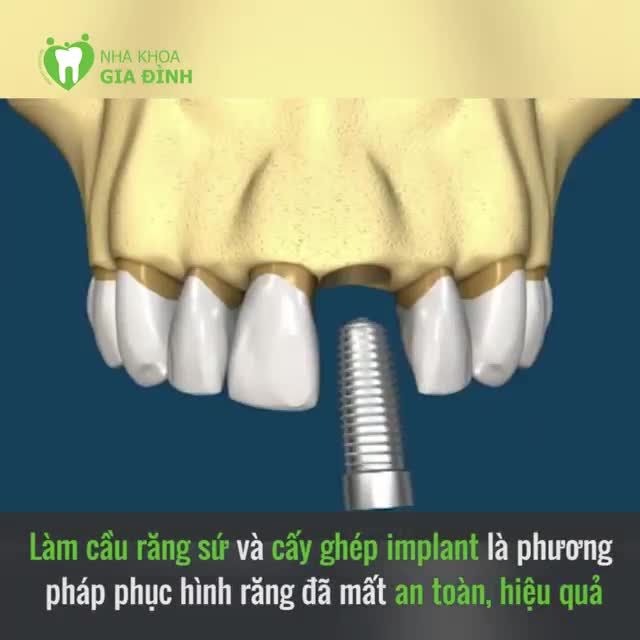 NÊN LÀM THẨM MỸ RĂNG SỨ HAY CẤY GHÉP IMPLANT CHO RĂNG ĐÃ MẤT