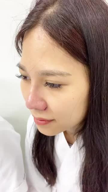 Nền mũi thấp - Cánh mũi bè to kém duyên