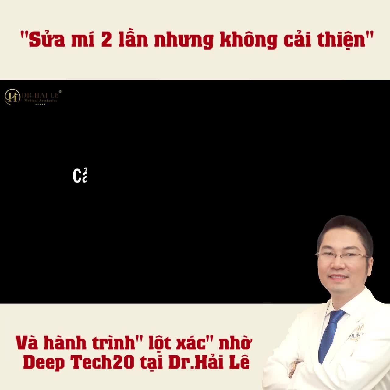 “Người ta 1 lần đã khó sửa, đằng này mình đến tận 2 lần, cứ nghĩ đến sửa mí lại chị lại thấy sợ, chỉ từ khi biết đến Dr.Hải Lê sự lo lắng của chị mới được giải quyết. Kết quả đây, thật sự thấy hài lòng”