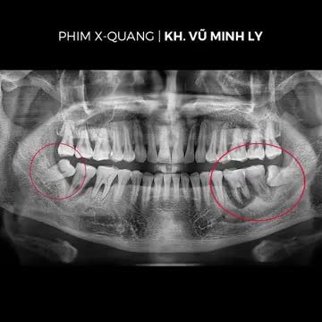 NHỔ RĂNG KHÔN KHÔNG ĐAU - KHÔNG SƯNG - KHÔNG CHẢY MÁU - ĐI LÀM NGAY