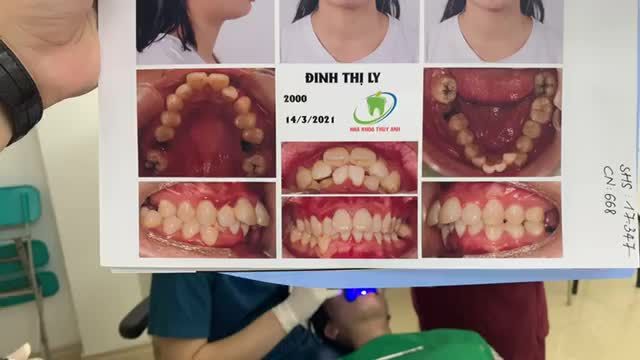 “Niềng răng càng sớm đẹp càng nhanh” – đó chính là lời khuyên chân thành từ bác sĩ chỉnh nha.