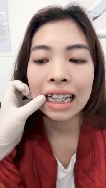 Niềng răng chữa hô - Khấp khểnh thế nào
