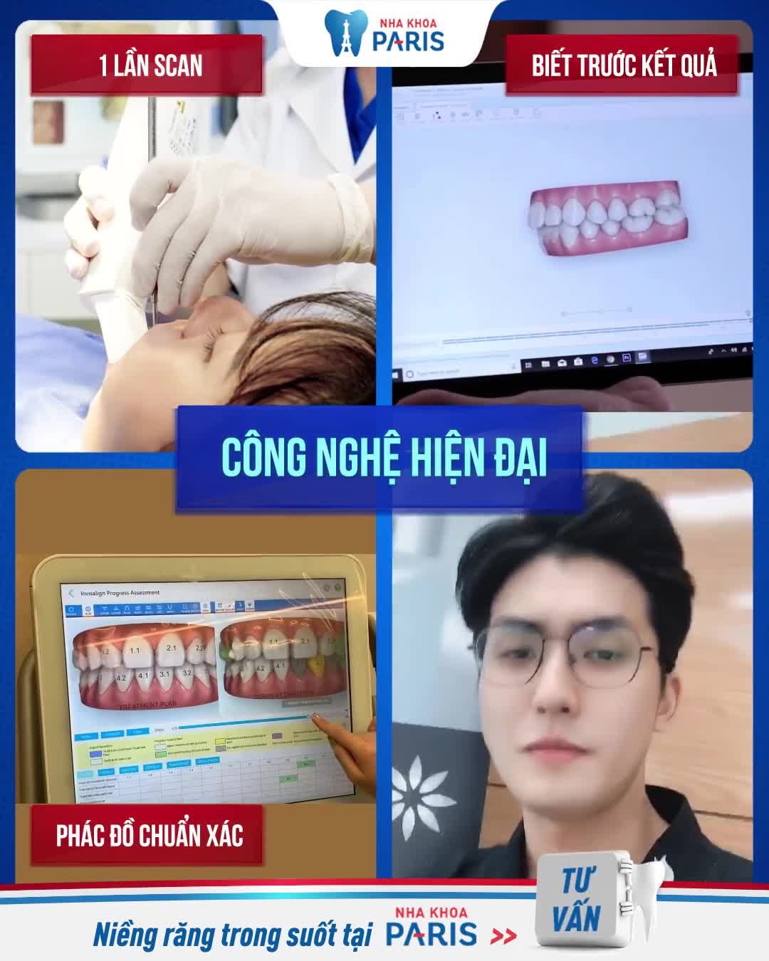 Niềng răng trong suốt - Xu hướng thẩm mỹ dẫn đầu