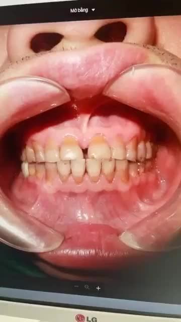 NỤ CƯỜI THAY ĐÔI GƯƠNG MẶT GHI ĐIỂM TUYỆT ĐỐI VỚI ĐƯỜNG CƯỜI NAM TÍNH