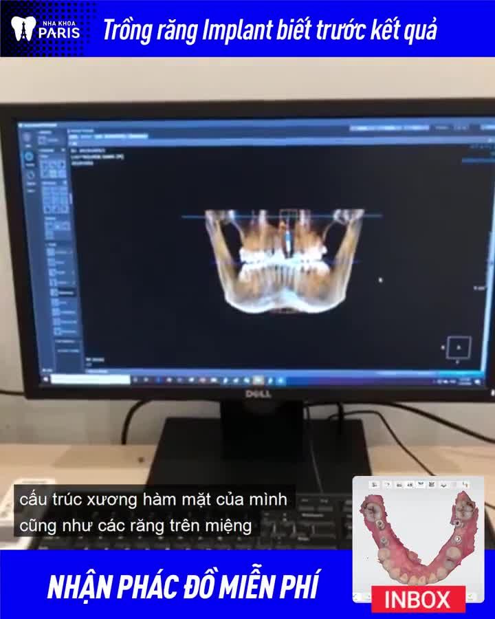 PHÁC ĐỒ CẤY GHÉP IMPLANT CHO KH NGUYỄN VĂN LƯU