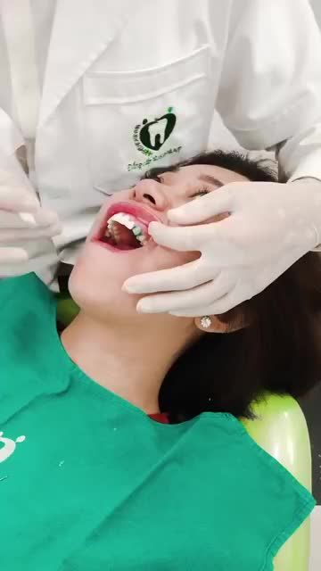 PHỤC HÌNH THẨM MỸ 18 RĂNG SỨ CHO MỘT CASE KHÁCH HÀNG NỮ