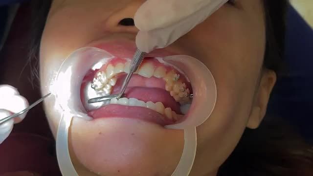 Phương án điều trị gắn mắc cài cho bệnh nhân răng Khấp khểnh
