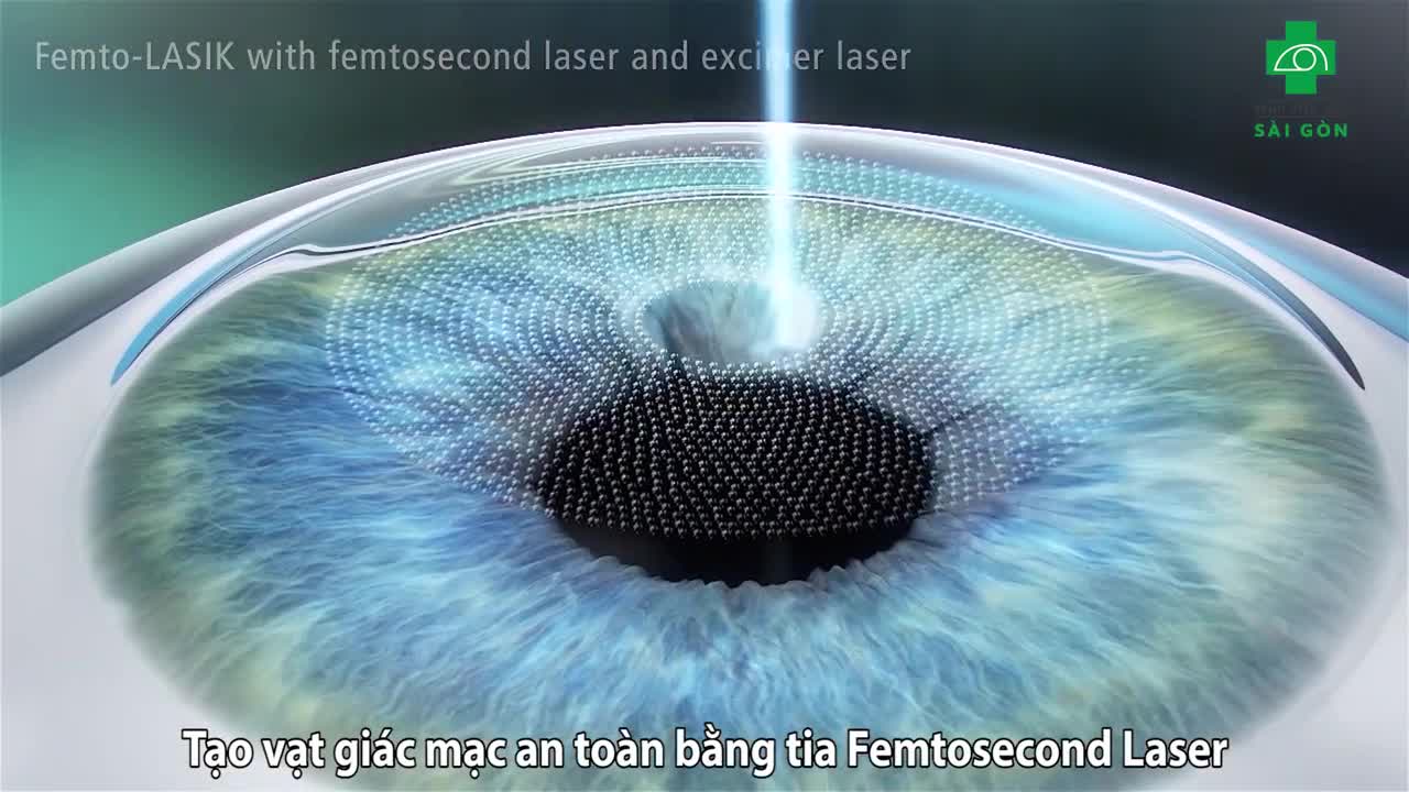 PHƯƠNG PHÁP XÓA CẬN FEMTOSECOND LASIK