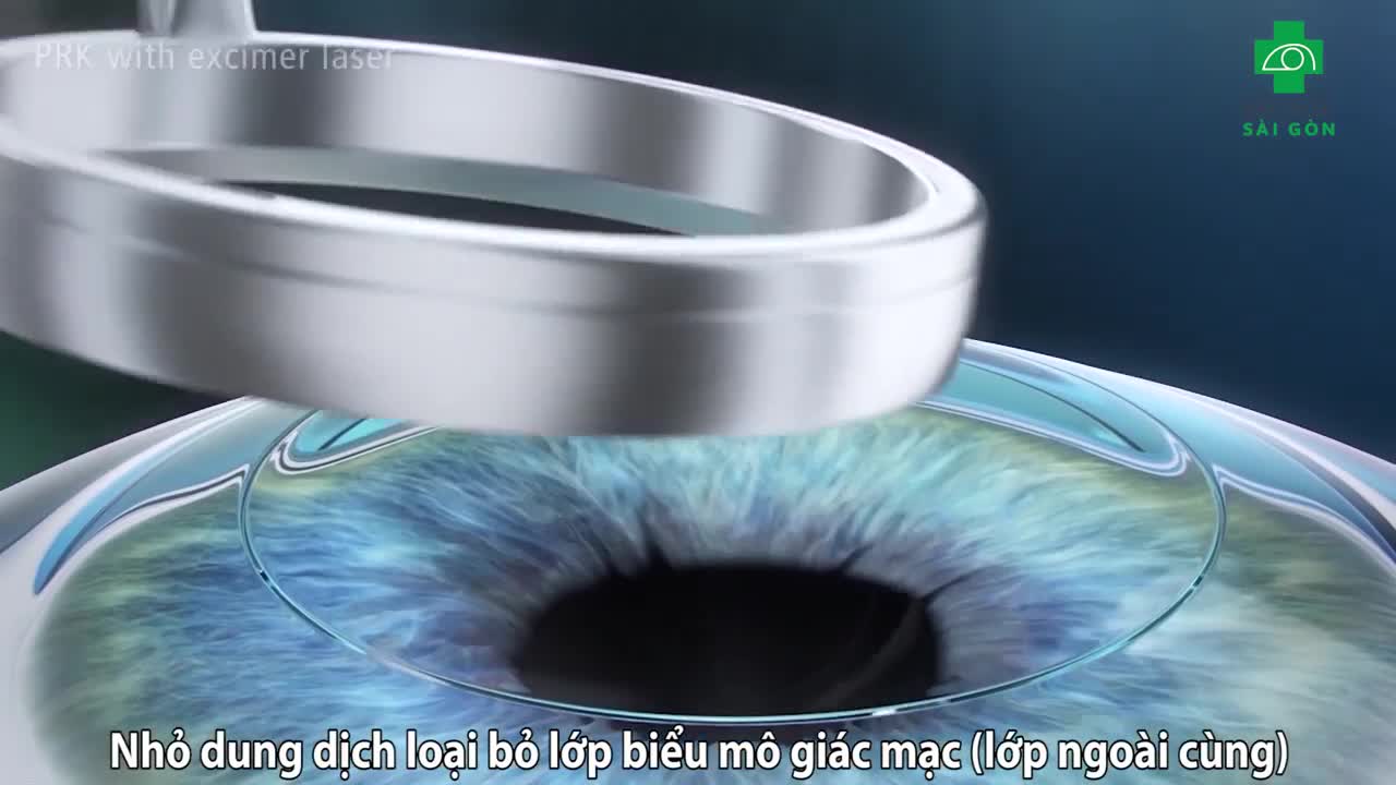 PHƯƠNG PHÁP XÓA CẬN PRK