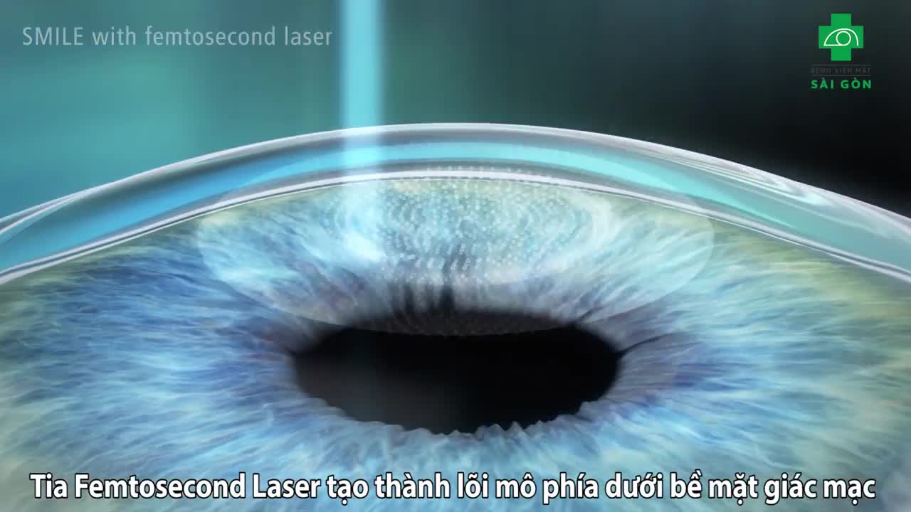 PHƯƠNG PHÁP XÓA CẬN RELEX SMILE