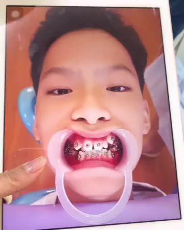Quả ngọt sau hơn 2 năm sống chung với "Răng Sắt"