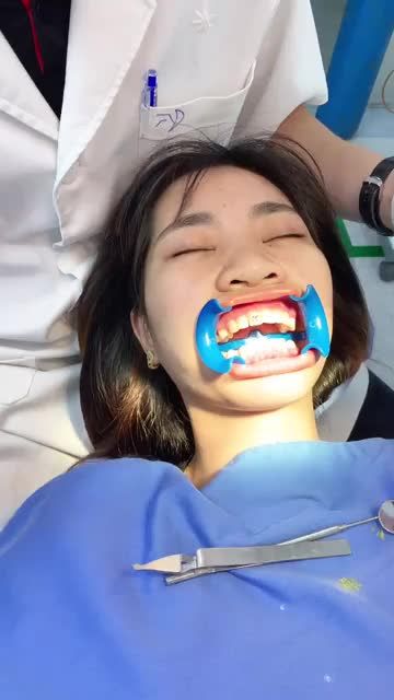Quy trình gắn mắc cài Niềng Răng