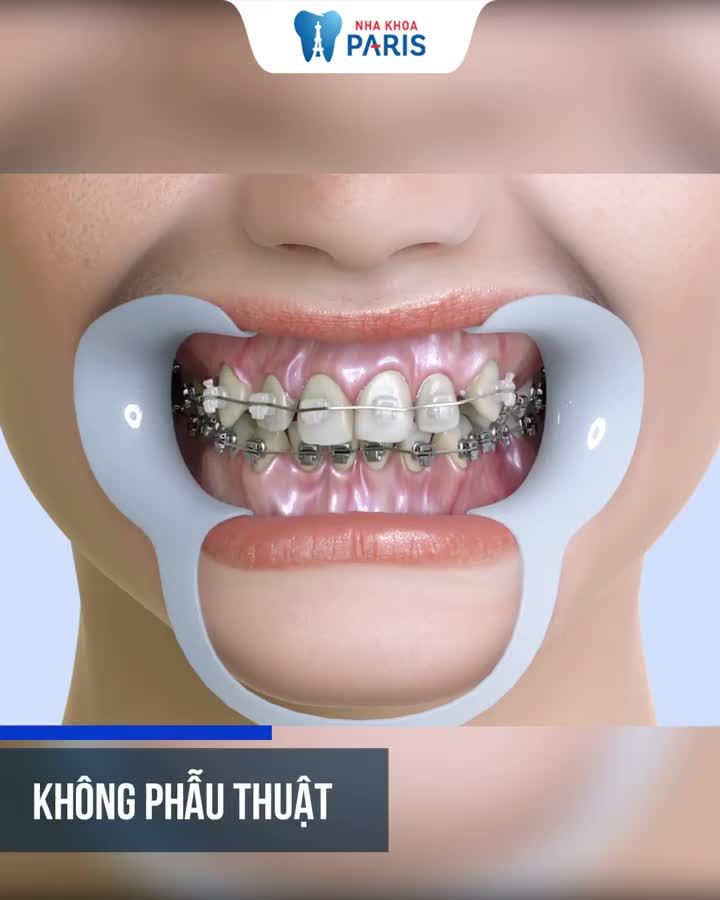 QUY TRÌNH NIỀNG RĂNG 3D SPEED