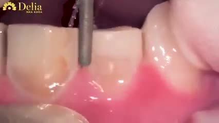 RĂNG ĐẸP - KHÔNG CẦN MÀI cùng công nghệ siêu mỏng vô hình Invisible - BIO INVIO 3I!