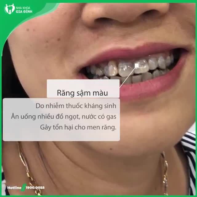 RĂNG SẬM MÀU NÊN CHỌN TẨY TRẮNG RĂNG HAY LÀM RĂNG SỨ THẨM MỸ