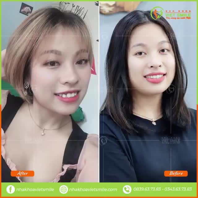 Review FEEDBACK khách hàng niềng răng + Cắt lợi