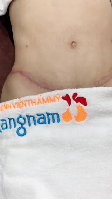 SẸO SINH MỔ: Đậm, dài, co kéo "Giải cứu" cho mẹ bỉm