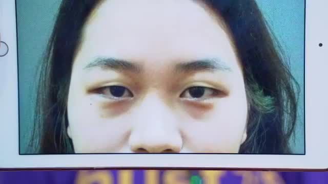 Sở hửu mắt 2 mí rạng rỡ sau 7 ngày thực hiện Cắt mí tại Dr.Hải Lê