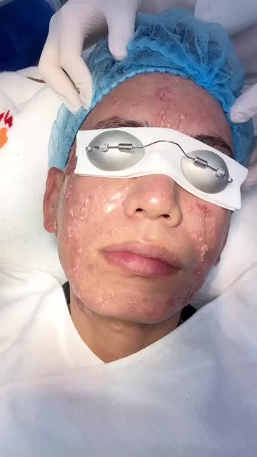 SỐC - nhà tôi 3 đời làm thẩm mỹ chưa thấy Sẹo Lồi nào nghiêm trọng như thế này Nhưng đừng lo! Kangnam sẽ có cách giải quyết với công nghệ điều trị Sẹo Lồi