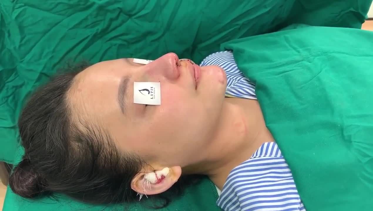 Sự thay đổi kỳ diệu ngay sau khi thực hiện combo sửa lại mũi lần 3 + độn cằm.